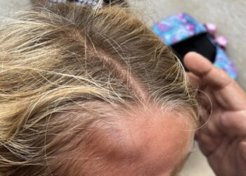 Comiso, cade calcinaccio e ferisce una bimba all’uscita da scuola