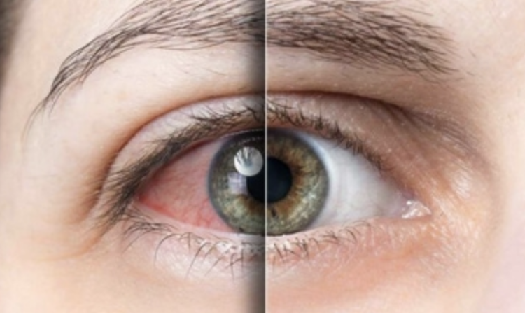 Ragusana rischia di perdere la vista, salvata con un intervento in un ospedale del Nord